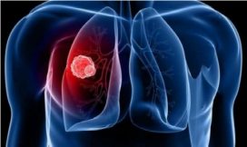 Туберкульоз: хто у групі ризику та чому важливий скринінг. Форми туберкульозу за чутливістю до лікування